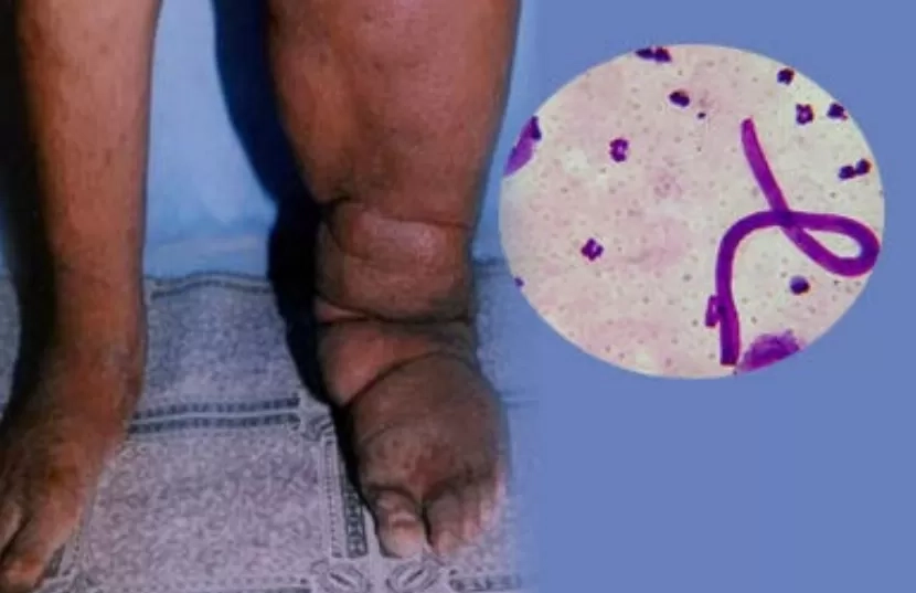 Waspada Filariasis! Mengenal Penyakit Kaki Gajah yang Mengintai Jutaan Orang dan Disebabkan oleh Gigitan Nyamuk