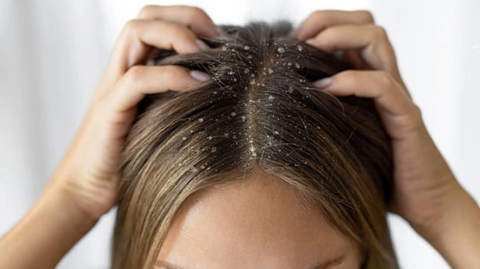 5 Rekomendasi Sampo Terbaik untuk Kulit Kepala Dermatitis Seboroik