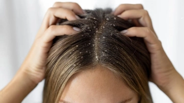 5 Rekomendasi Sampo Terbaik untuk Kulit Kepala Dermatitis Seboroik