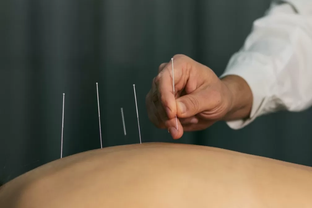 Memahami Akupunktur: Asal Usul, Cara Kerja, dan Dampaknya bagi Kesehatan
