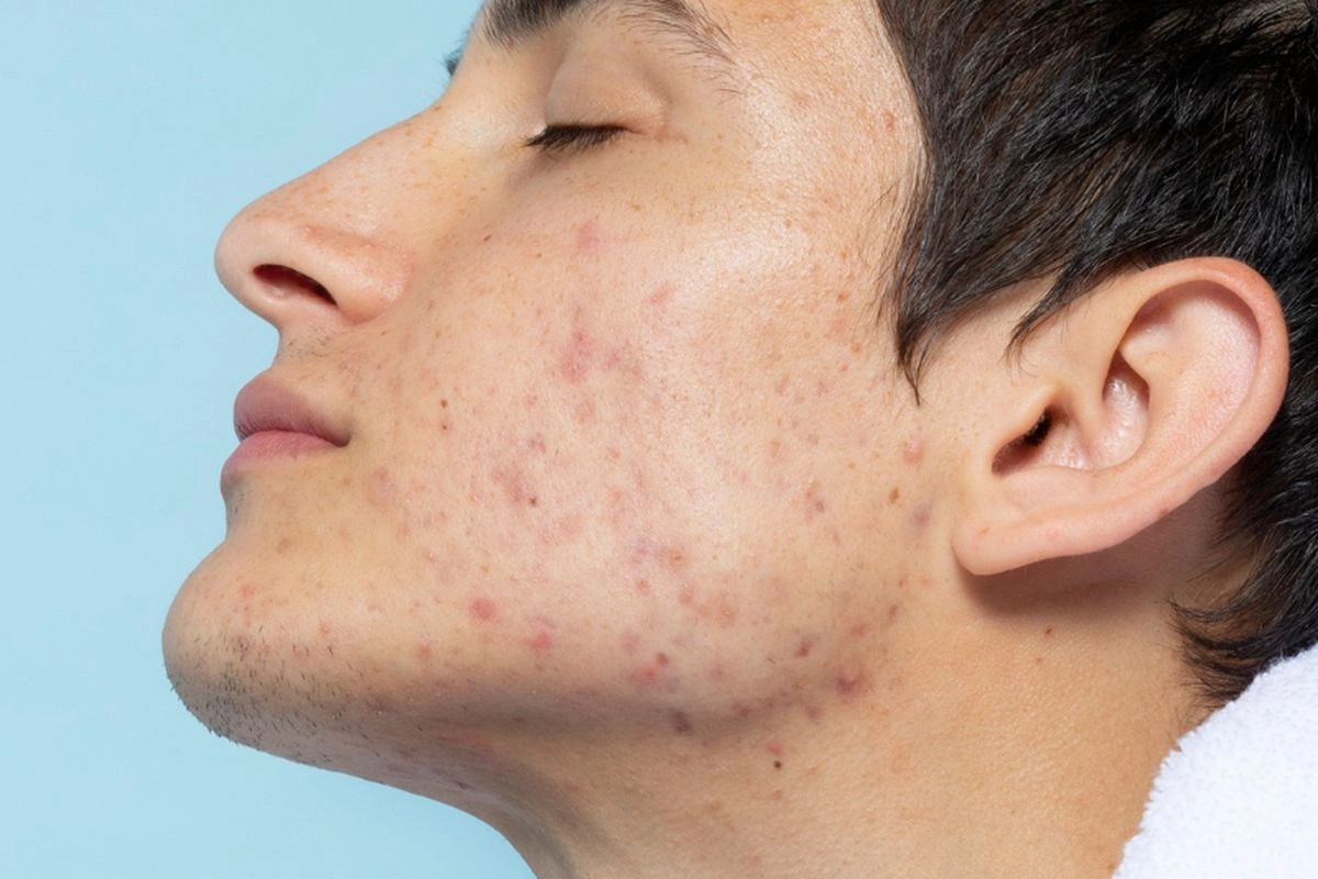 Gonta-ganti Skincare Bisa Picu Jerawat dan Beruntusan, Ini Kata Dokter