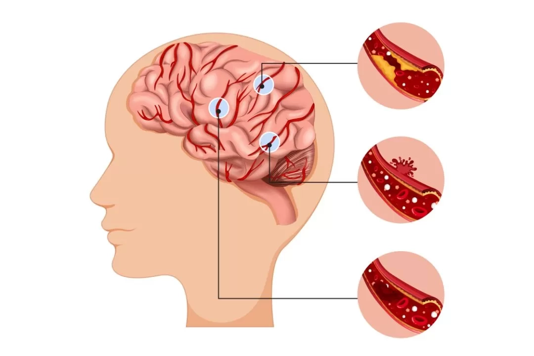 Cerebral Bypass Sebuah Solusi Penting untuk Pencegahan Stroke di Indonesia