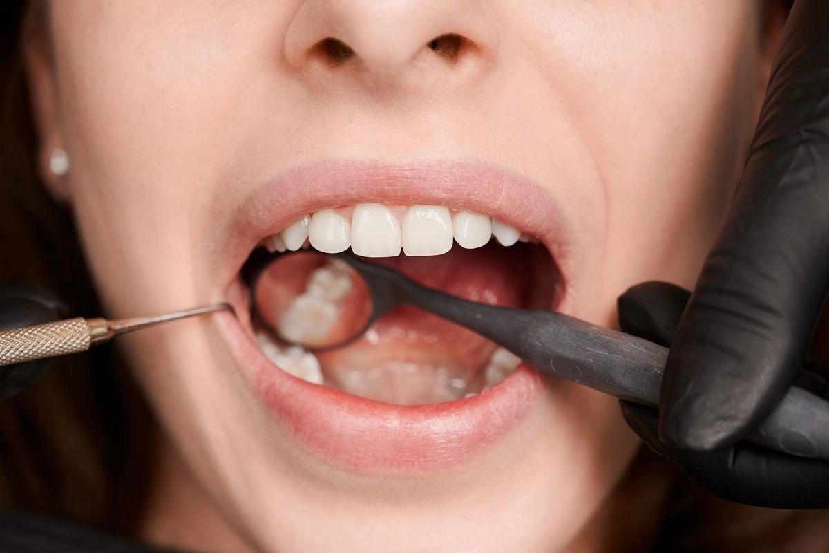 Plak Gigi Bisa Picu Penyakit Serius, Ini 5 Cara Mencegahnya