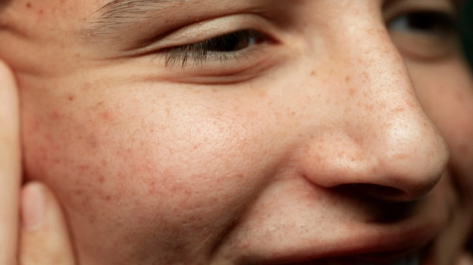 Waspada! Krim Pemutih Instan yang Anda Pakai Bisa Merusak Ginjal Permanen, Ini Penjelasan Dokter