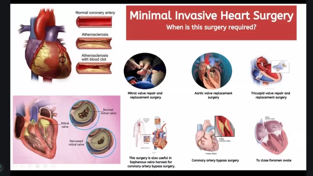 Tangani Kebocoran Jantung dengan 3 Tindakan Kompleks, Pertama di Indonesia dan Ketiga di Dunia