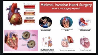 Tangani Kebocoran Jantung dengan 3 Tindakan Kompleks, Pertama di Indonesia dan Ketiga di Dunia