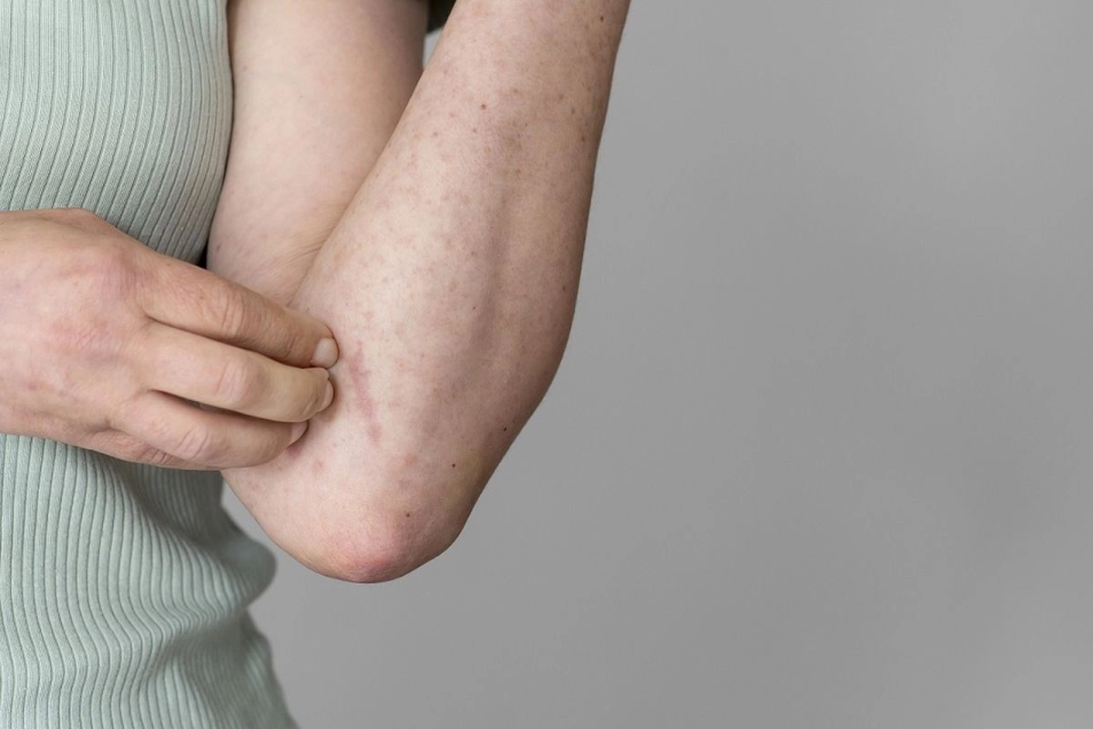 Dua WNI Terdiagnosis Kusta di Rumania, Kasus Pertama Setelah 40 Tahun