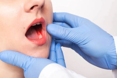 Ketahui, CIri-ciri Gusi Sehat dan Bermasalah