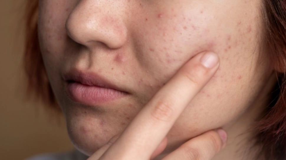 10 Kebiasaan Skincare yang Bisa Membuat Jerawat Muncul Lebih Parah