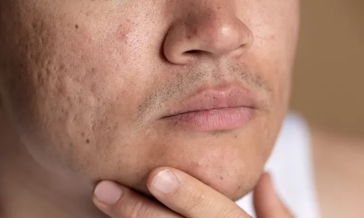 5 Cara Mengurangi Tampilan Pori-Pori Terbuka, Wajah Jadi Tampak Halus Merata