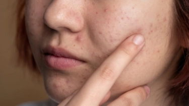 5 Sabun Muka Salicylic Acid untuk Sembuhkan Jerawat, Bantu Menenangkan Kulit