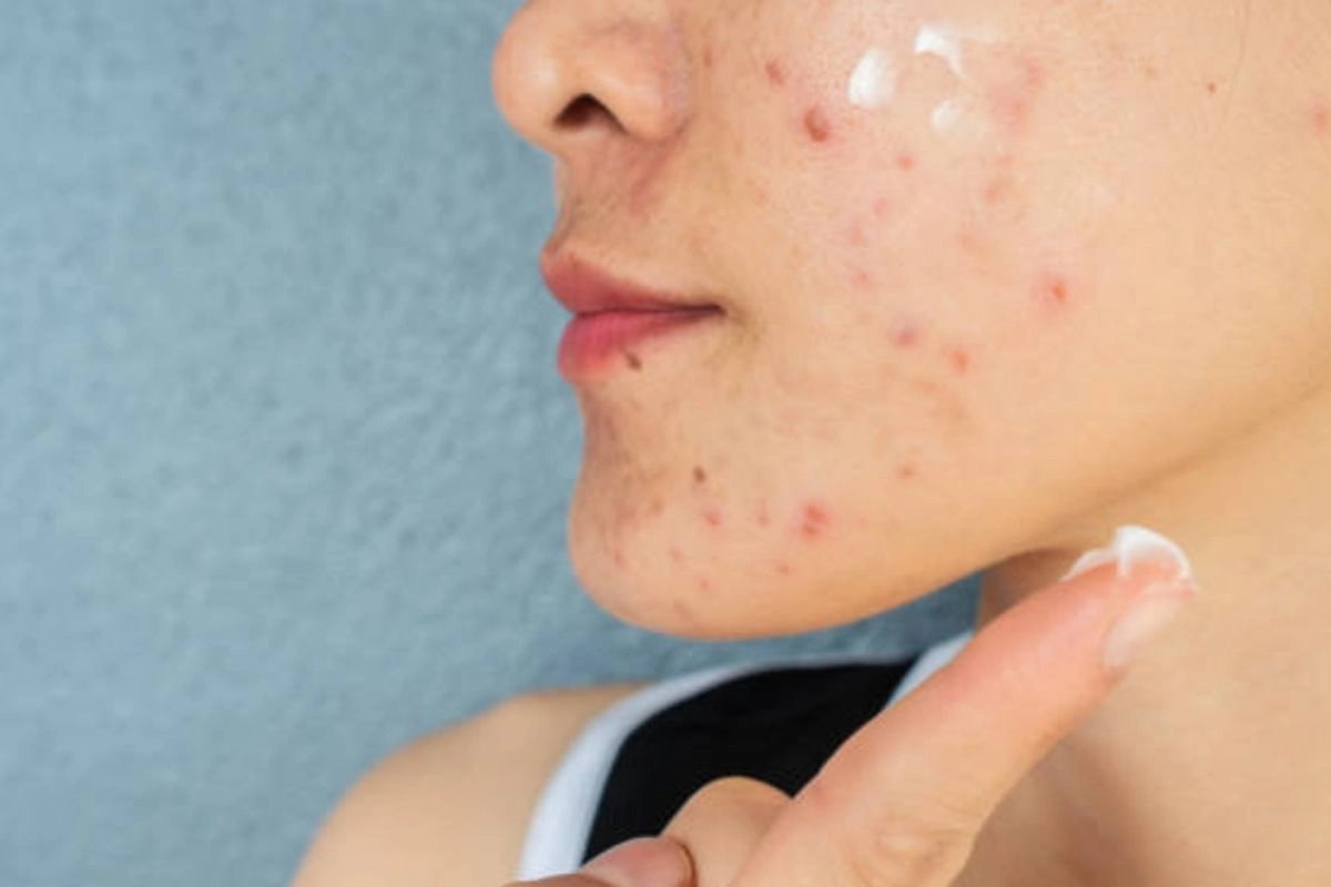 Kondisi Kulit Bisa Jadi Alarm Stres Tubuh, Ini 8 Tandanya Menurut Dokter