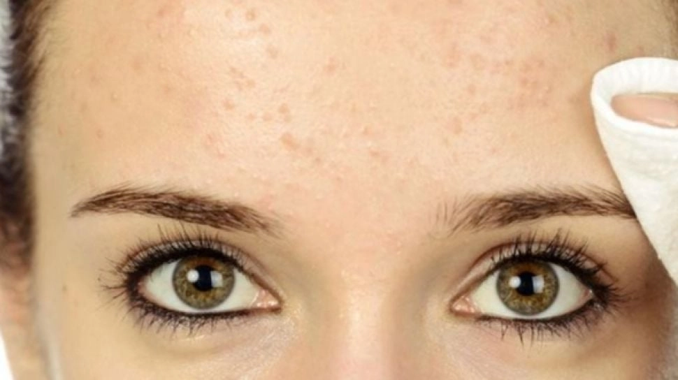 5 Rekomendasi Skincare untuk Bruntusan di Jidat, Mulus Kembali dengan Mudah