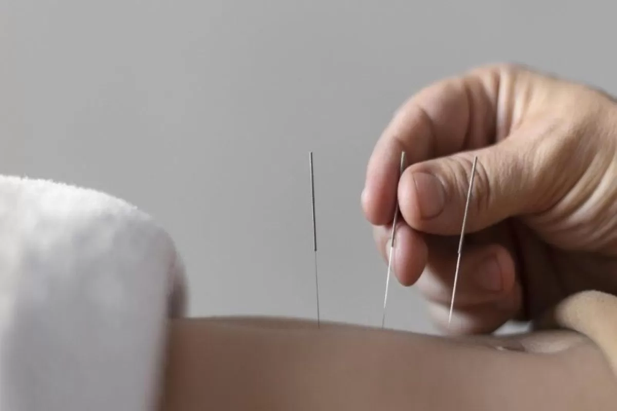 Dokter Sebut Akupuntur Wajah Jadikan Kulit Tampak Lebih Cerah dan Segar