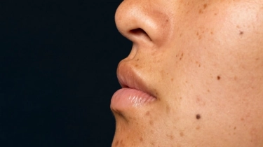 Terpopuler: Bahaya Pencet Jerawat di Segitiga Kematian Wajah, Daftar Kontroversi Bupati Sudewo