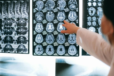 Gejala Epilepsi Bukan Cuma Kejang, Ketahui Mitos Keliru Lainnya