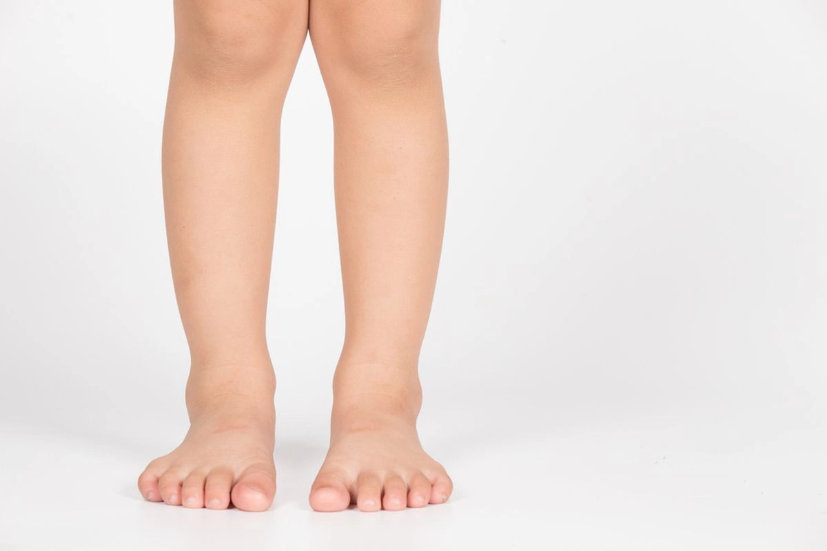 Bentuk Kaki X dan O pada Anak, Kapan Orangtua Harus Waspada?