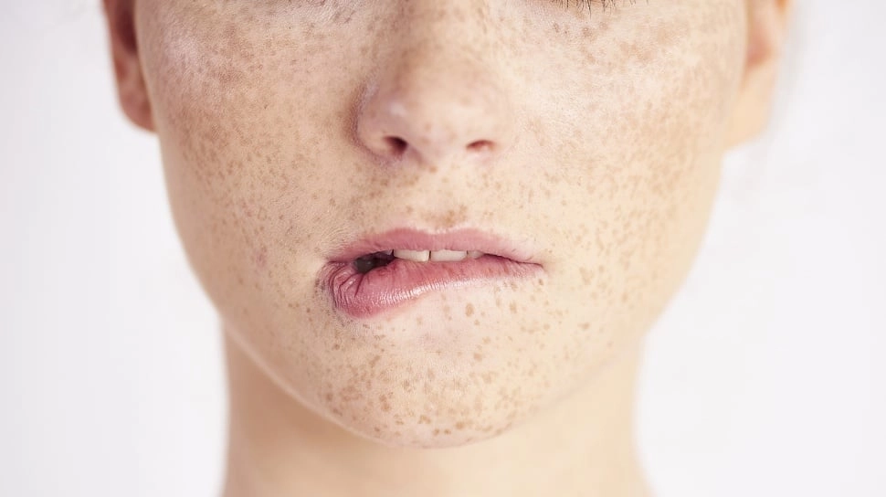 Bopeng di Wajah Bisa Hilang dengan Apa? Ini 4 Skincare untuk Perbaiki Tekstur Kulit