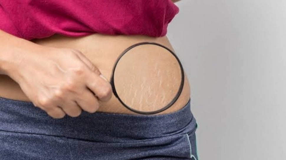 Apakah Stretch Mark Bisa Hilang? Ini 3 Rekomendasi Krim untuk Memudarkannya