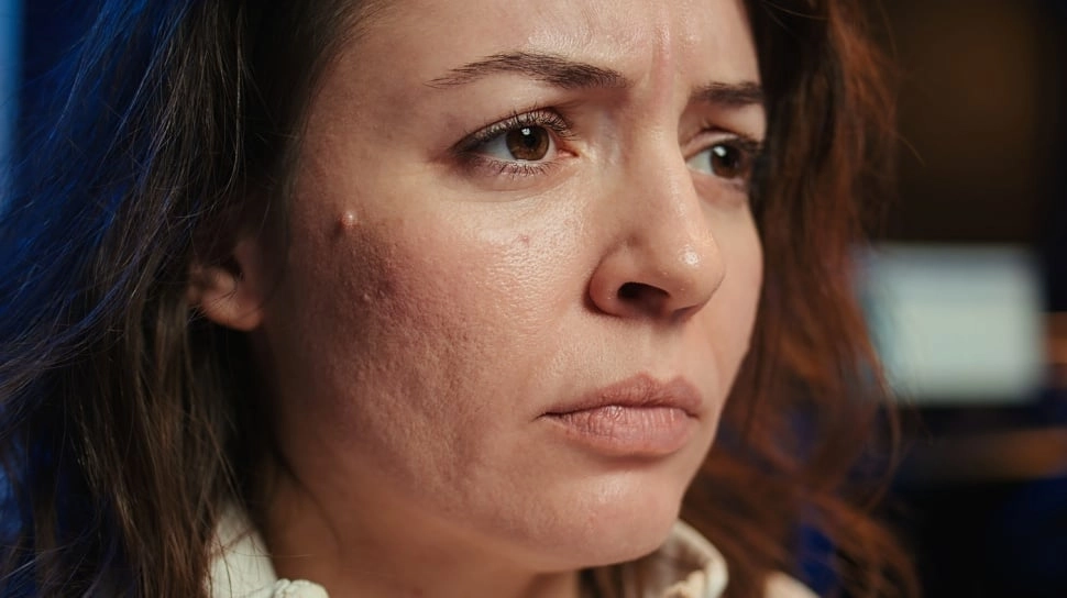 3 Cara Memulihkan Skin Barrier Rusak Menurut Dokter Estetika