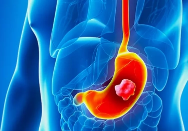 Waspadai Bakteri H.pylori Pemicu Kanker Lambung, Deteksi Dini jadi Kunci