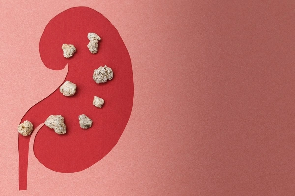 6 Faktor yang Meningkatkan Risiko Batu Ginjal, Bukan Hanya Kurang Minum