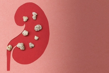 6 Faktor yang Meningkatkan Risiko Batu Ginjal, Bukan Hanya Kurang Minum