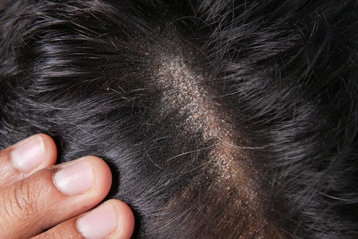 Benarkah Pria Lebih Rentan Ketombe hingga 7 Kali Lipat? Ahli Jelaskan Fakta dan Tips Pencegahannya
