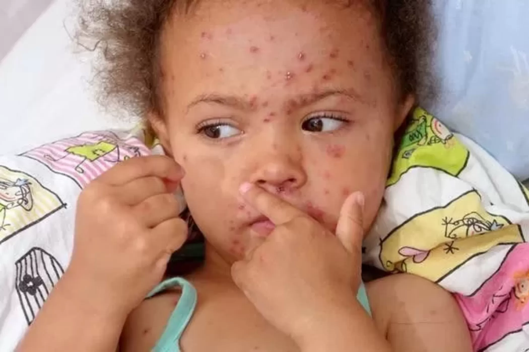 IDAI Ingatkan Campak Bukan Penyakit Ringan, Berisiko Komplikasi Serius