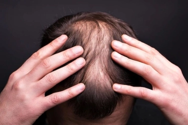 Mengapa Transplantasi Rambut Bisa Gagal? Ini Penjelasan Dokter