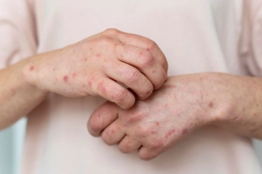 Gejala 3C, Cara Membedakan Campak dan Rubella