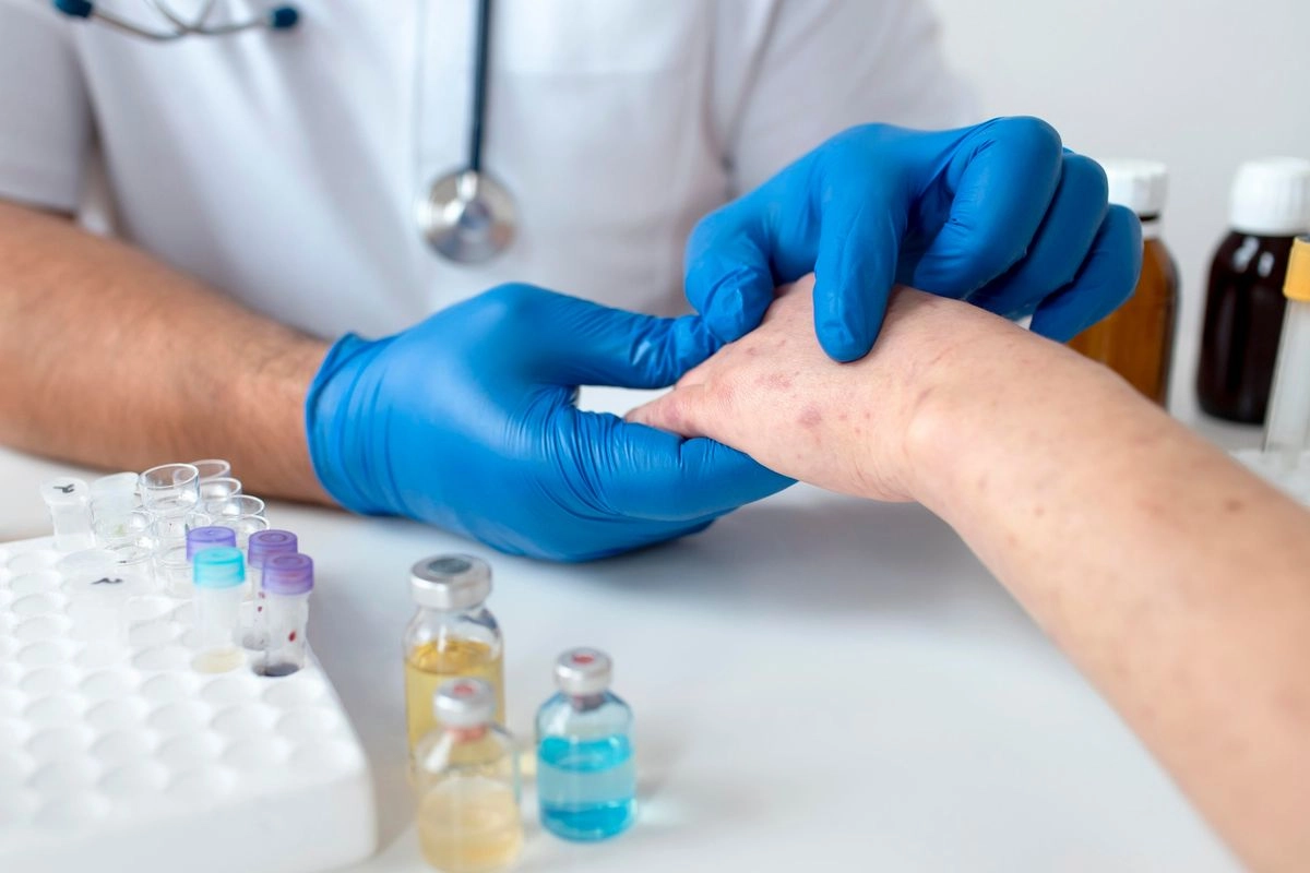 Indonesia Nomor 2 Dunia Kasus Campak, Ini Bahayanya Menurut Dokter