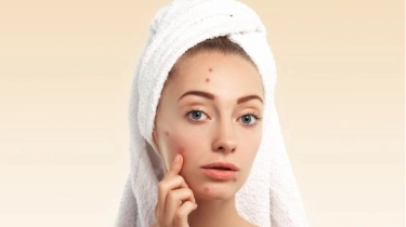 Jerawat Makin Parah Setelah Pakai Skincare Baru? Ini Perbedaan Breakout dan Purging