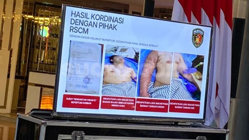 Update Kondisi Medis Andrie Yunus, RSCM: Mata Bakal Ditutup 6 Bulan Demi Pemulihan Intensif