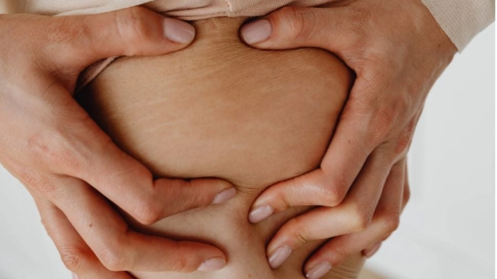 5 Rekomendasi Krim untuk Stretch Mark, Bantu Kulit Tampak Lebih Halus
