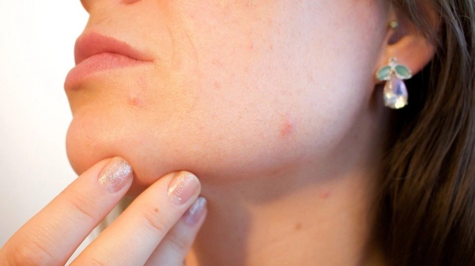 Apa Penyebab Jerawat di Dagu? Ini 4 Rekomendasi Acne Spot Treatment Terbaik