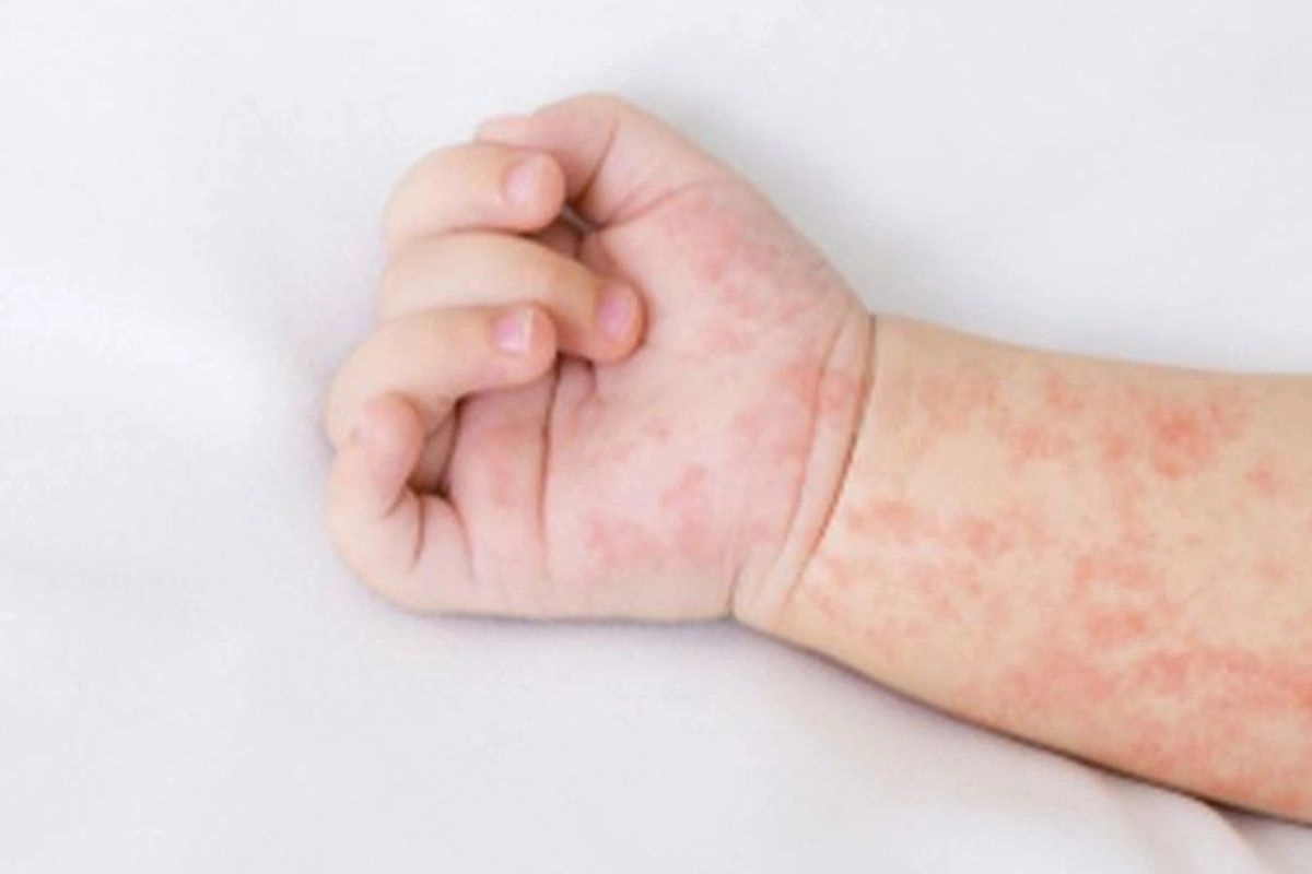 IDAI Sebut Campak dan Difteri Lebih Mendesak dari Hantavirus, Ini Alasannya