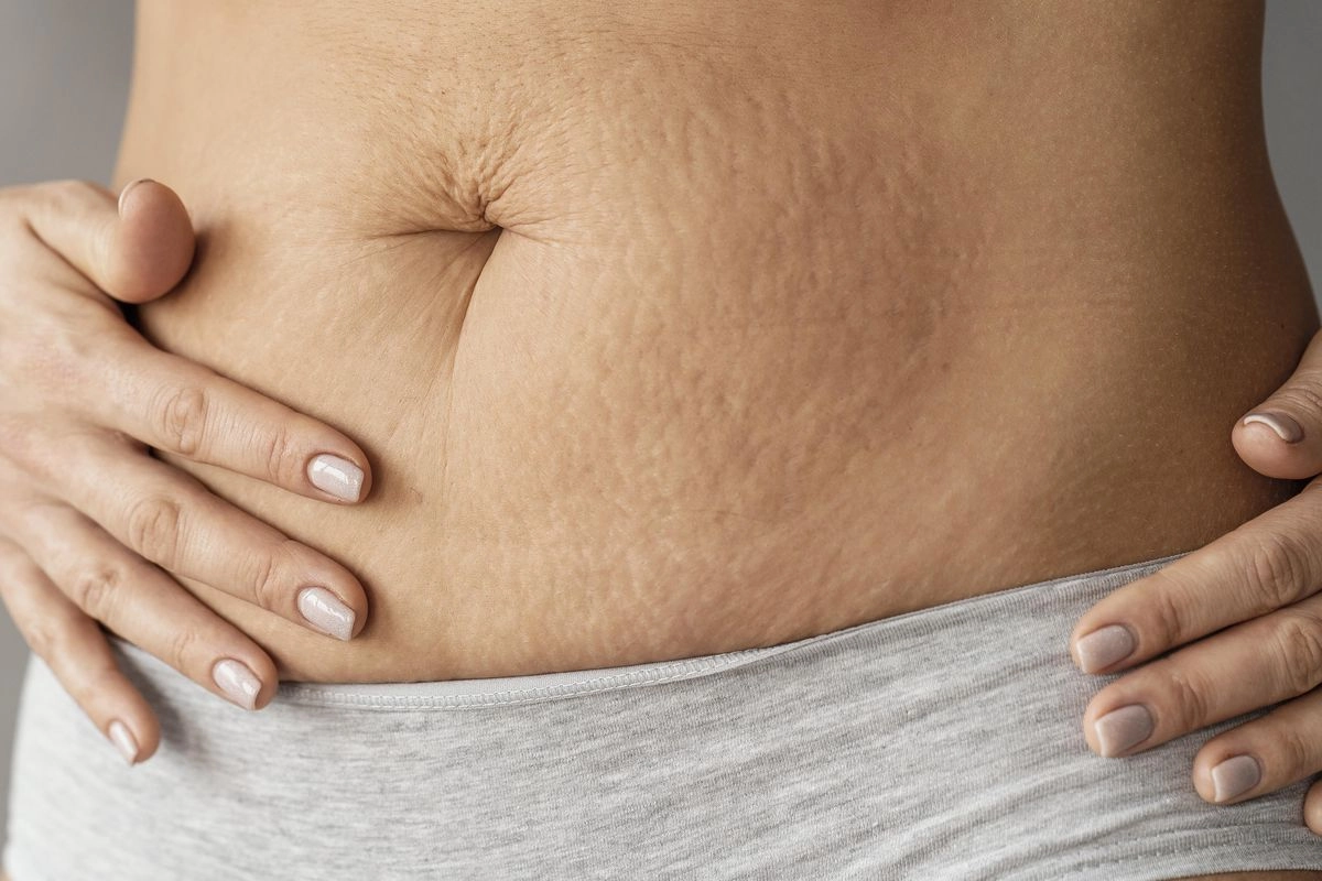 Kurang Kolagen Bisa Memicu Stretch Mark, Bisakah Diatasi?